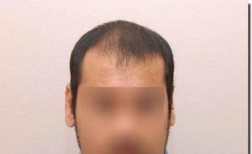 Hair restoration procedure results