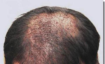 Hair restoration procedure results