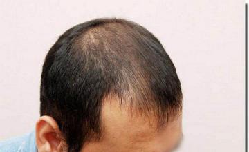 Hair restoration procedure results