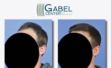 Hair transplantation surgery before and after photos