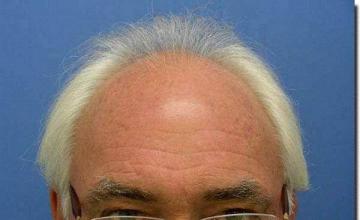 Hair restoration procedure results