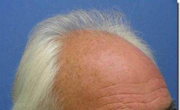 Hair restoration procedure results