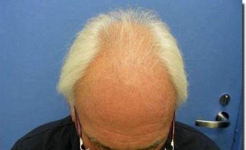 Hair restoration procedure results