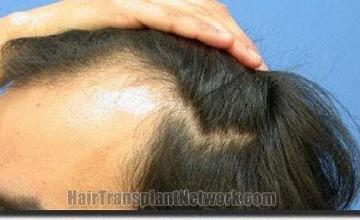 Hair restoration procedure results