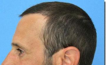 Hair restoration procedure results