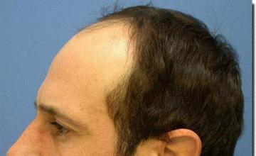 Hair restoration procedure results