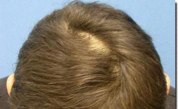 Hair restoration procedure results