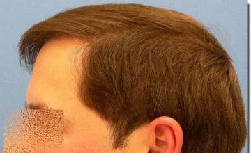 Hair restoration procedure results