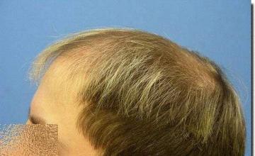 Hair restoration procedure results