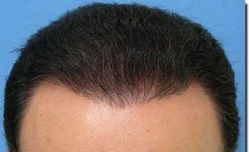 Hair restoration procedure results