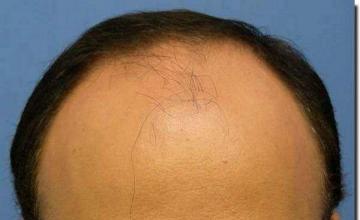 Hair restoration procedure results