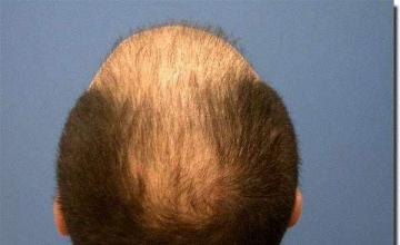 Hair restoration procedure results