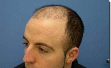 Hair restoration procedure results