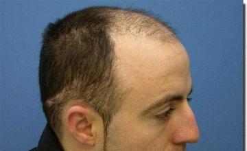 Hair restoration procedure results