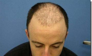 Hair restoration procedure results