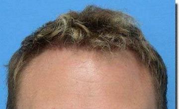 Hair restoration procedure results