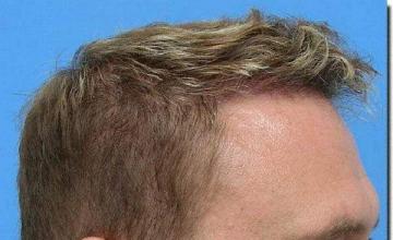 Hair restoration procedure results