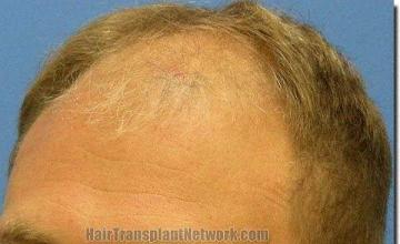 Hair restoration procedure results