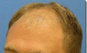 Hair restoration procedure results