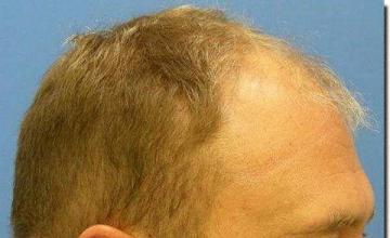 Hair restoration procedure results