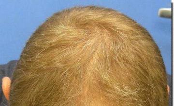 Hair restoration procedure results