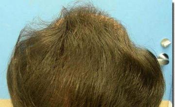 Hair restoration procedure results