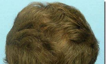 Hair restoration procedure results