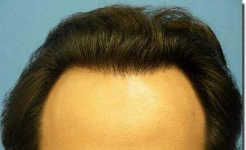 Hair restoration procedure results