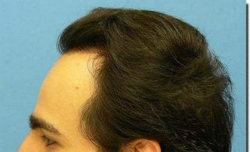 Hair restoration procedure results