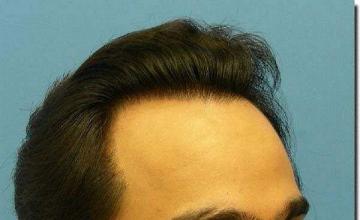 Hair restoration procedure results