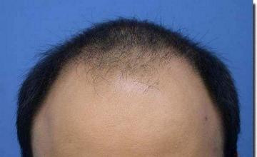 Hair restoration procedure results