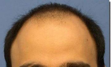 Hair restoration procedure results