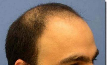 Hair restoration procedure results