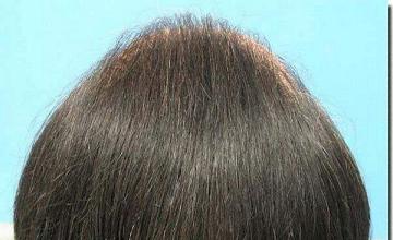 Hair restoration procedure results