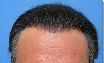 Hair restoration procedure results