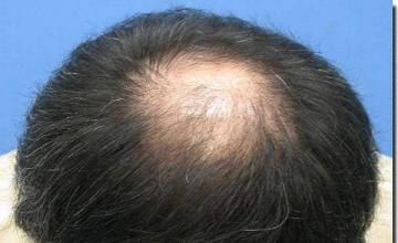 Hair restoration procedure results