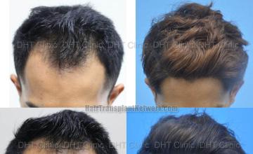 Before and after hair restoration procedure images