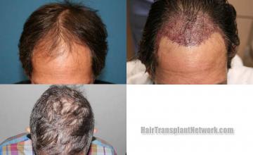 Before and after hair restoration procedure images