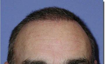 Hair restoration procedure results