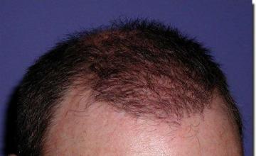 Hair restoration procedure results