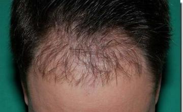 Hair restoration procedure results