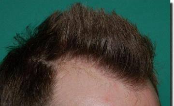 Hair restoration procedure results