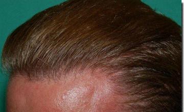 Hair restoration procedure results