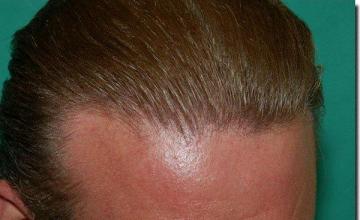 Hair restoration procedure results