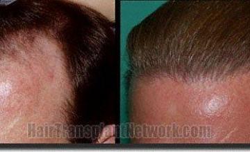 Hair restoration procedure results