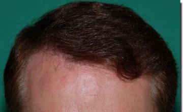 Hair restoration procedure results