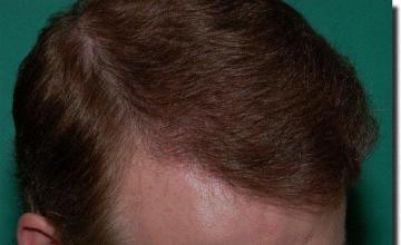 Hair restoration procedure results