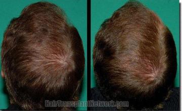 Hair restoration procedure results