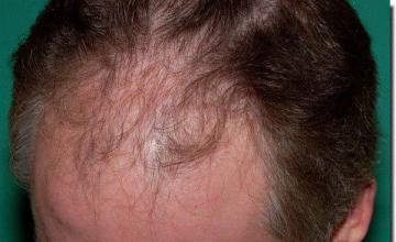 Hair restoration procedure results