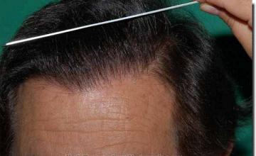 Hair restoration procedure results